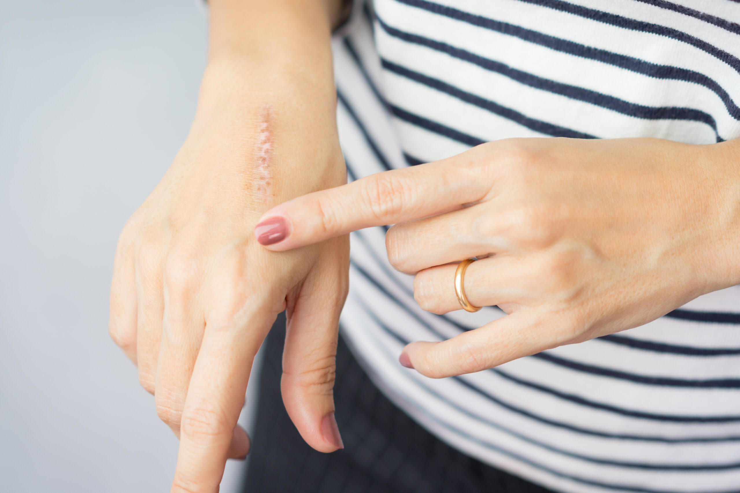 Close up of cooking oil burn scar on a woman's hands. The skin damage in first-degree on outer layer skin. Healing, Removal, Treatment, Accident in the kitchen, Scar, Scald, Wound Healing concept.